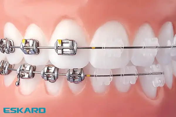 نحوه مراقبت از دندان در دوران ارتودنسی