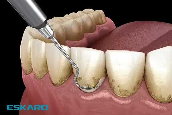 تفاوت تارتار دندان با پلاک دندان