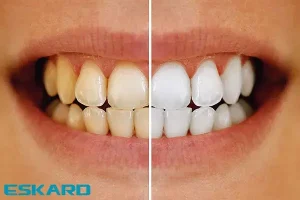 تارتار دندان چیست